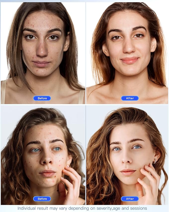 lumaderm™ Infared Red Light Face Mask